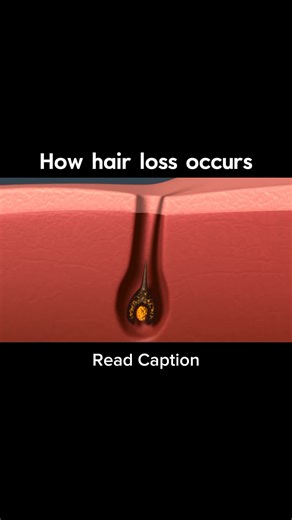 What you need to know about hair loss 🧬 Androgenic Alopecia (Genetic Hair Loss) This type of hair loss is caused by a hormone called DHT, which shrinks hair follicles over time. The result? Thinner strands, slower growth, and eventually, follicle dormancy. 😰 Stress-Induced Hair Loss (Telogen Effluvium) Excessive stress shocks the system, pushing a large number of hair follicles into the resting (shedding) phase. The result is sudden, diffuse hair thinning that can last for months if not manage