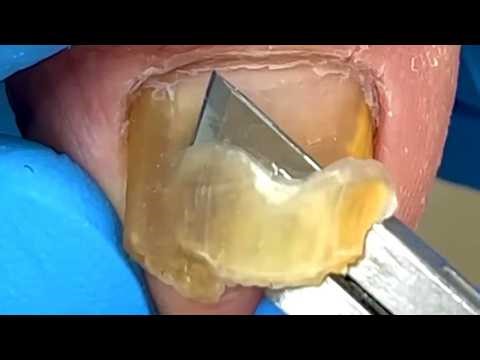 The Whole Process Of Nail Fungus Treatment Gentle Pedicure【Xue Yidao】