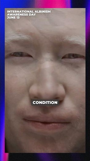 June 13: International Albinism Awareness Day
