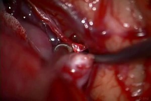 Aneurysm Clip Surgery - Middle Cerebral Artery - About the Surgeon and Procedure - Live Surgery and Chat with Dr. Spetzler