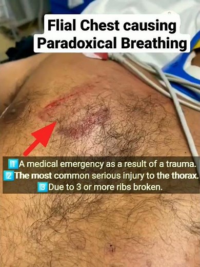 Injury to Chest causing Paradoxical Breathing