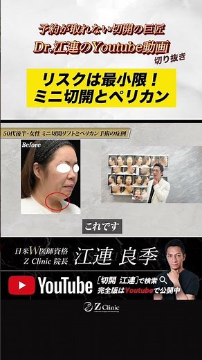 [Dramatic Rejuvenation] Minimal Risk | Mini-Incision Facelift and Pelican Surgery | YouTube Clip