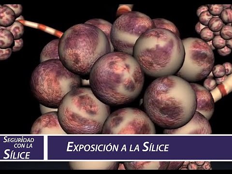 Exposición a la sílice