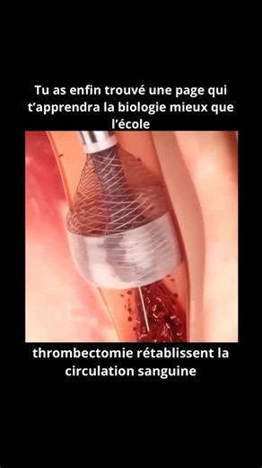 Biologie.Explicative on Instagram: "Les dispositifs de thrombectomie sont des outils médicaux vitaux utilisés pour rétablir rapidement la circulation sanguine lorsqu’un caillot bloque une artère essentielle, le plus souvent lors d’un AVC ischémique 🧠⏱️. Lorsque l’oxygène n’arrive plus au cerveau, chaque minute compte. Ces dispositifs permettent aux médecins de retirer physiquement le caillot, au lieu de se fier uniquement aux médicaments, réduisant ainsi fortement le risque de lésions cérébrale