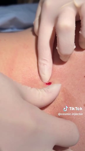 Another punch biopsy... are we surprised?? 🤣 📍Cosmic at Aesthetic and Dermatology Center #dermatology #biopsy #nursepractitioner #medicine #aesthetic