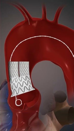 You're skipping step #3 #pulse3dmedia #3dmedicalanimation