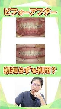 【親知らずを活かす矯正・ビフォーアフター】親知らずを利用した症例