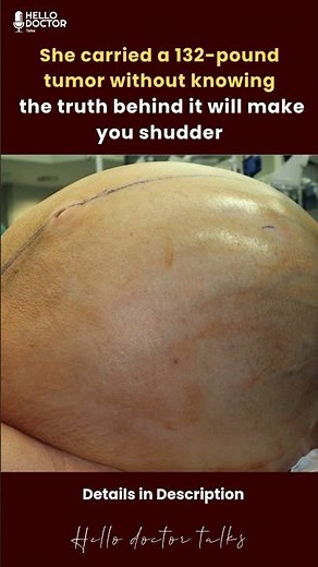 She carried a 132-pound tumor without knowing the truth behind it will make you shudder #health
