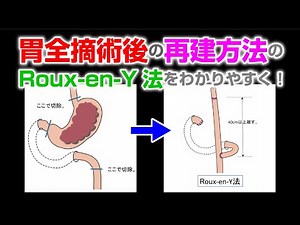 胃全摘術後の再建方法のRoux-en-Y法をわかりやすく！