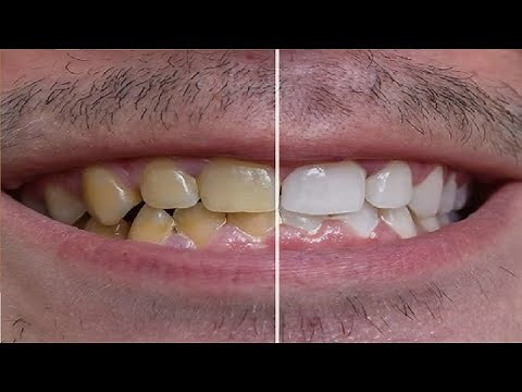 how to get rid of yellow teeth naturally DO THIS