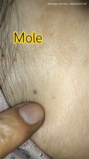 Mole or Blackhead