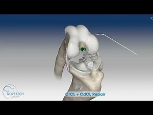 Global stifle disruption (CrCL + CdCL rupture ) with NOVALIG®