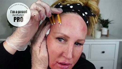 DIY Thread Series: Brow Lift with Cog Threads