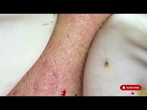 Clinical Comedone Extraction: Deep Facial Cleansing for Severe Acne