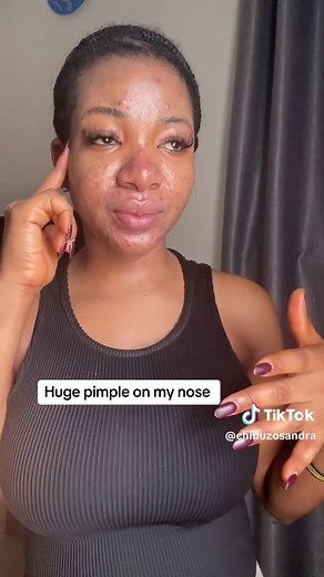 #creatorsearchinsights Inflamed nose breakouts are so painful and embarrassing #acneproneskin #inflamednose #nosepimple #acne #acne #acnetips #acnefighter #chibuzosandra