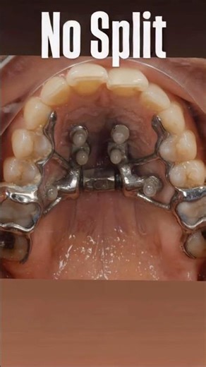 No split - split with advanced design MARPE F.A.C.E. protocol