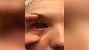 Doctor operated on wrong eye, tried to fix mistake with no anesthesia, lawsuit says
