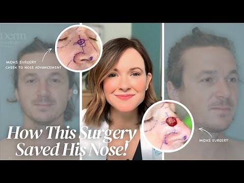 Mohs Surgery with Cheek to Nose Advancement: Before and After