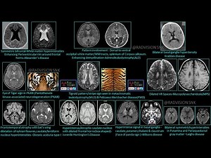 Pediatric Neuroradiology -Rare but classic cases (RBC) set III