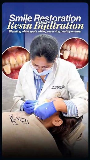White Spot Removal Without Veneers | Resin Infiltration Smile Transformation
