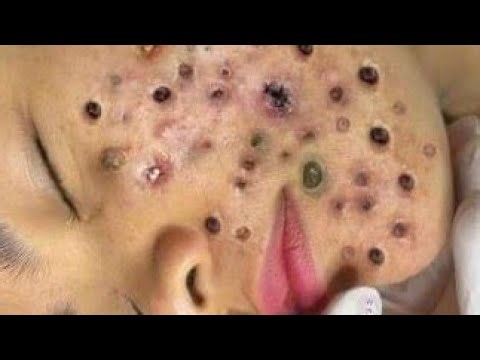 Deep blackhead Removal 2026, acne removal spa, big pimple 2026, #acne #pimple #cyst