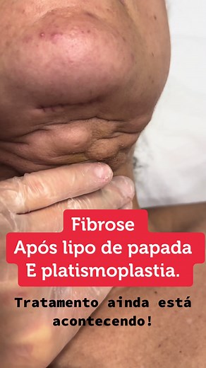 Tudo sobre Lipo de Papada e Pós-Operatório