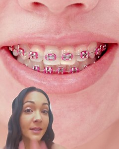 Start with a £10 impression kit (free after return) Code: SAVE2SMILE | Smile Direct Club