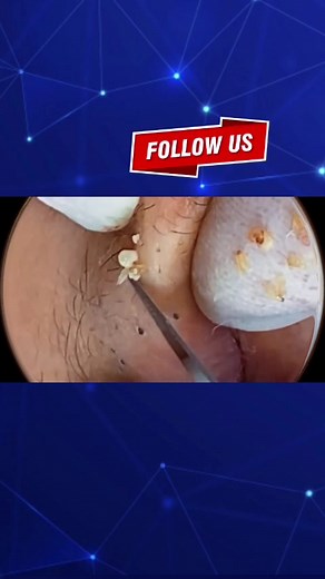 Pimple Satisfying on TikTok