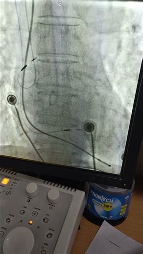Bachman Bundle pacing With LBBB pacing