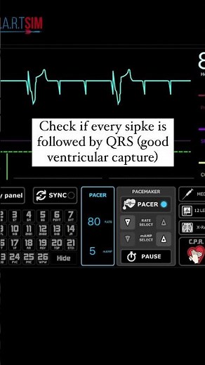 How to set up a Transcutaneous Pacemaker?