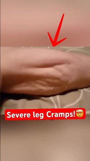What a Real Leg Cramp Looks Like