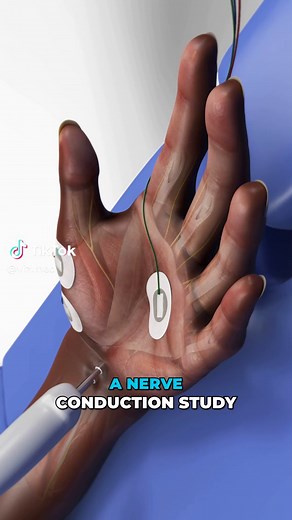 A nerve conduction study measures how fast electrical signals travel through your nerves to detect damage or compression. Sticky electrodes are placed along the skin, and a brief electrical pulse stimulates the nerve while a computer records how quickly the signal moves. Healthy nerves transmit signals rapidly, while slower speeds may indicate irritation, injury, or conditions like carpal tunnel syndrome. #NerveConductionStudy #Neurology #NervePain #3DMedicalAnimation #MedicalAnimation #PatientE