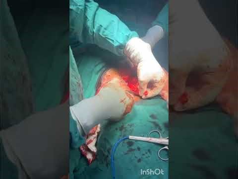 Ileostomy closure part-1