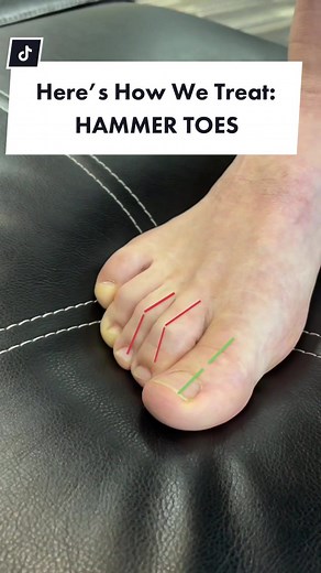 Effective Treatment for Hammer Toes