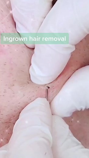 #greenscreenvideo #yoyomcn #pimplepopping #pimpleremover #extractions #zitpopper #ingrownhair #ingrownhairremoval Satisfying