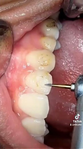 Polishing teeth after bracket removal | Braces Removal