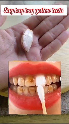 Teeth Whitening Tips: Home Remedies and Techniques