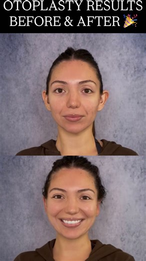 SAGAR PATEL MD Buccal l Chin Lipo l Ear Pinning on Instagram: "Finally getting ear pinning surgery just in time for the holidays 🤩🥰🎄🎉 #otoplasty #otoplastia #earpinning #earpinningsurgery #earpinningsurgeon #otoplastysurgery #otoplastybeforeandafter #otoplastysurgeon #otoplastyexpert"