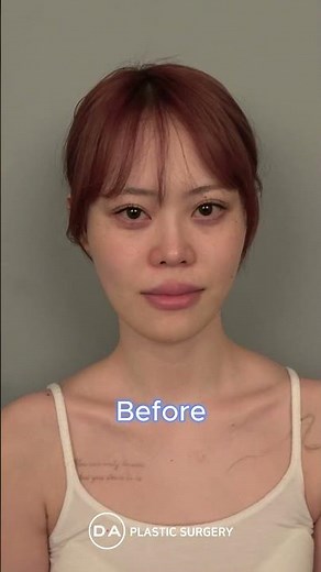 ［韓国整形］両顎・輪郭手術レイちゃんBeforeAfter🩷🩷［DA美容外科