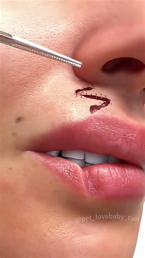 Z-Plasty And V-Y Plasty (3D Animation)#zplasty #plasty #draw #shape #zshape #scar #puzzle