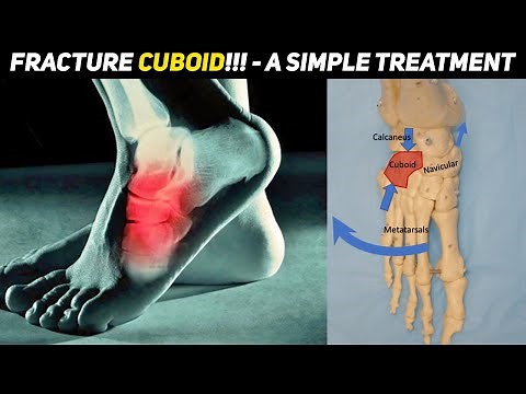 Fracture Cuboid!!! - A Simple Treatment Dr. Soundar
