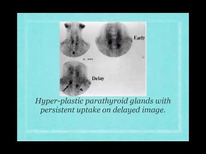 3 Parathyroid scan Ekram Ali