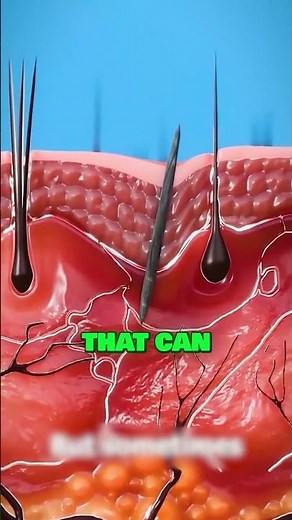 How To Remove A Splinter😖