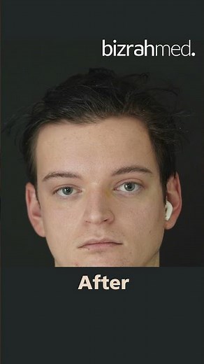 Stunning before & after results of an eyebrow and forehead lift | Dr. Bizrah | London/Dubai/(1207)