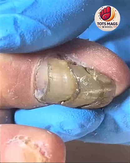 24K views · 185 reactions | Essential Tips for Overgrown Toenails Without Harsh Chemicals #NailFixTips #SafeNailCare #ThickToenailCare #ToenailSupport | Tots Mags Wheel | Facebook