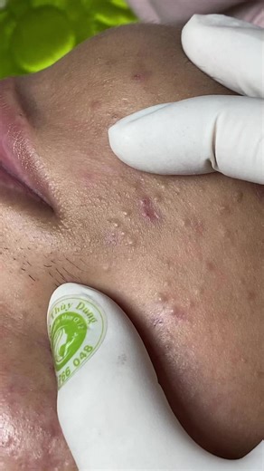 Tuyến bã #SpaThuỳDung #chuyênmụnq12