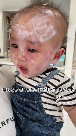 赤ちゃんの水疱瘡体験と治療経過