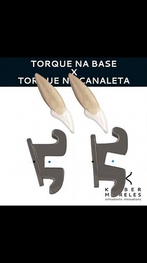 TORQUES - ORTHODONTIC TIPS #Shorts