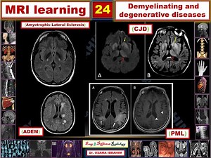 MRI learning 24 Demyelination and degenerative diseases