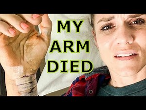 ARM APOCALYPSE! | POST SURGERY CAST COMES OFF AND I LOOK LIKE A ZOMBIE